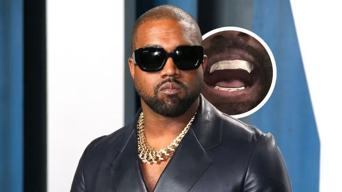 Völlig verrückt? Kanye West gönnt sich Titan-Zahnersatz