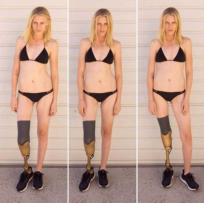 La modelo que perdió su pierna derecha por caminar incorrectamente.